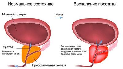 Нормальная и воспаленная простата