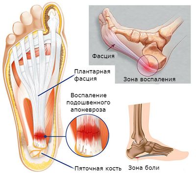 Плантарная фасция или апоневроз