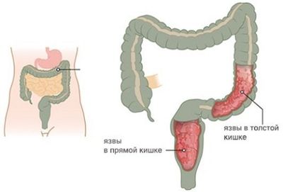 Язвенный колит кишечника