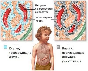 Причины детского диабета