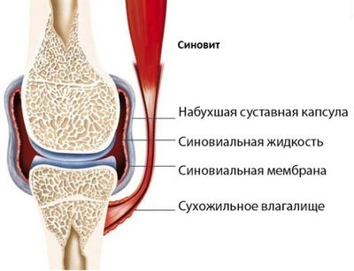 Признаки, виды и терапия синовита коленного сустава