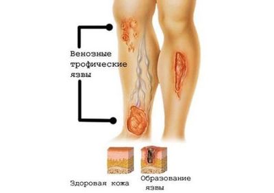 Трофические язвы на ногах