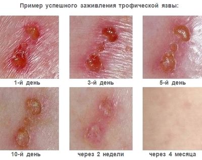 Показание к применению - трофические язвы