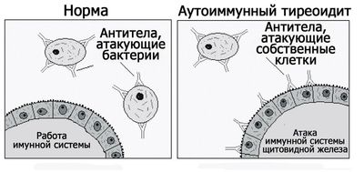 схема аутоимунный тиреоидит