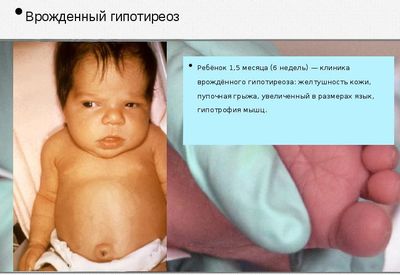 врожденный гипотиреоз