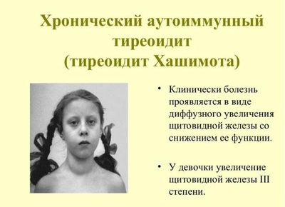 аутоиммунный тиреоидит