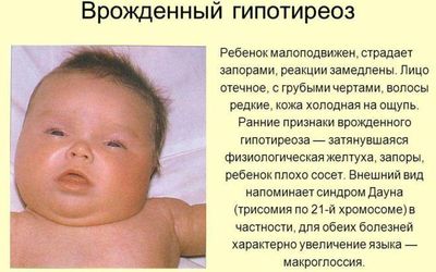 врожденный гипотиреоз