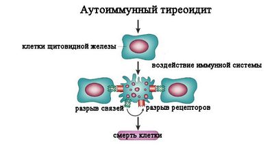 Развитие аутоиммунного тиреоидита