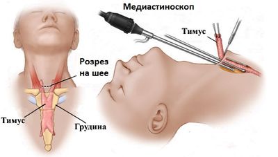 удаление тимуса схема