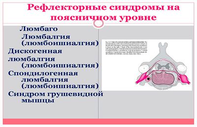 Рефлекторные синдромы на поясничном уровне