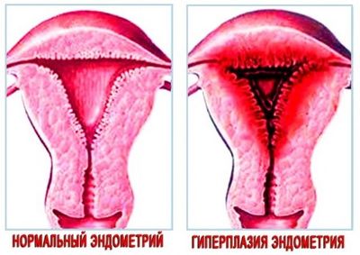 Выделения из влагалища при эндометрите