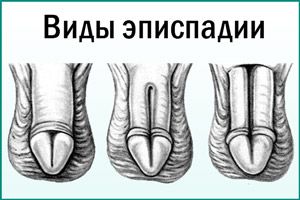 Виды Эписпадии