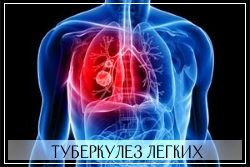 Мазь Випратокс противопоказана при туберкулезе легких