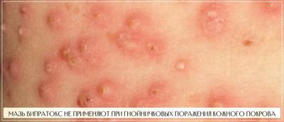 Випратокс не назначают при гнойничковых поражениях кожи