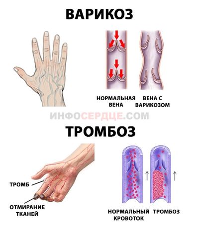 Варикоз и тромбоз