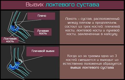 Вывих локтя