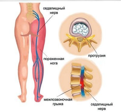 Воспаление седалищного нерва, причины, симптомы и лечение в домашних условиях
