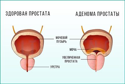 Заболевание простаты