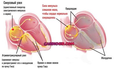 Замедление внутрипредсердной проводимости: что это такое, причина и лечение