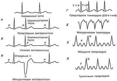 Экстрасистолия у детей и подростков: причины, как распознать и лечить