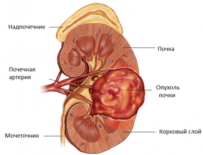 Ангиомиолипома почки