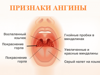Антибиотик при ангине ребенку - какие лучше принимать детям