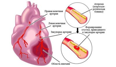 атеросклероз аорты сердца