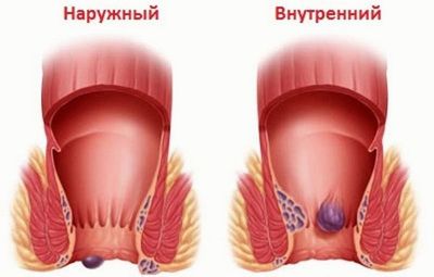 Геморрой