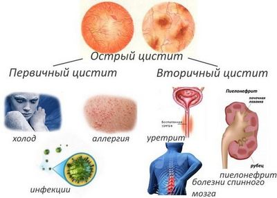 Цистит