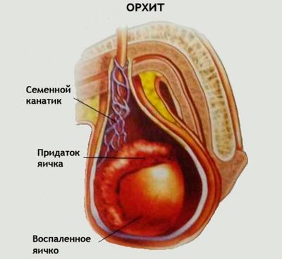Орхит у мужчин