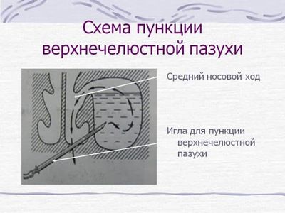 sxema-punkcii-verxnechelyustnoj-pazuxi