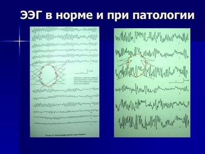 Что такое ЭЭГ головы у детей фото