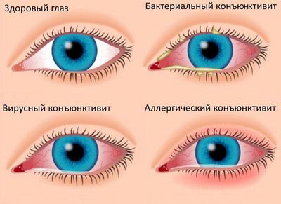 Симптомы конъюктивита