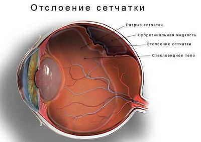Отслоение сетчатки глаза