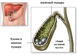 камни в желчном