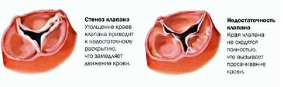 Поражение трехстворчатого клапана