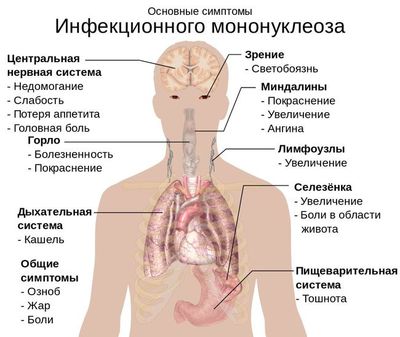 Инфекционный мононуклеоз