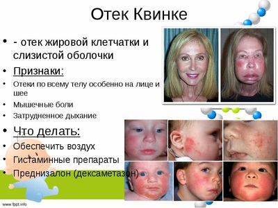 Отек Квинке