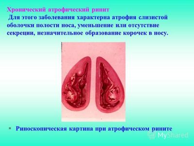 Атрофический ринит