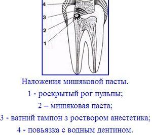 девитализация пульпы