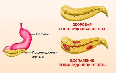 здоровая и воспаленная поджелудочная железа