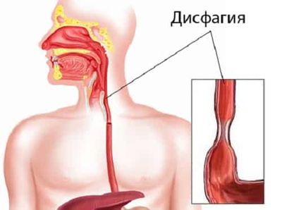 Дисфагия
