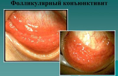 Фолликулярный конъюнктивит симптомы