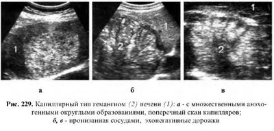 Капиллярный тип гемангиомы