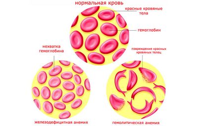 Как лечится гемолитическая анемия и ее симптомы