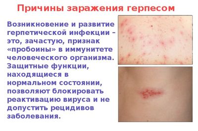 причины проявления герпеса