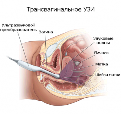 Трансвагинальное обследование