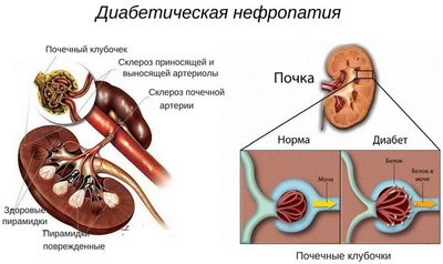 Нефропатия