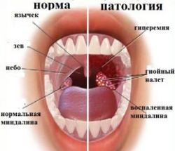 Паратонзиллярный абсцесс