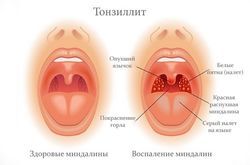 Тонзиллит